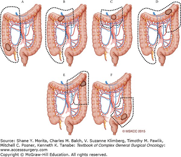 Ung thư đại tràng 2