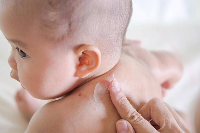 Chăm sóc trẻ điều trị zona