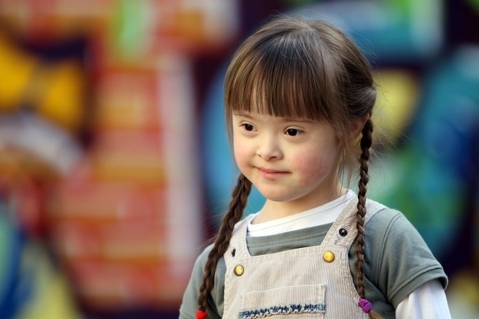 Bệnh Down có chữa được không? - ảnh 2