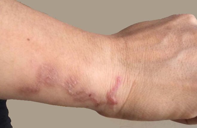 Cơ chế hoạt động của ấu trùng sán lợn gạo - ảnh 1