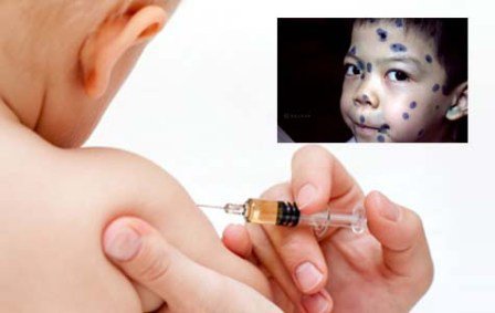 Tiêm phòng vacxin thủy đậu