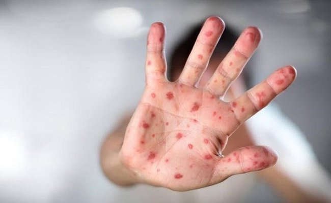 Bệnh tay chân miệng làm xuất hiện mụn nước trên da