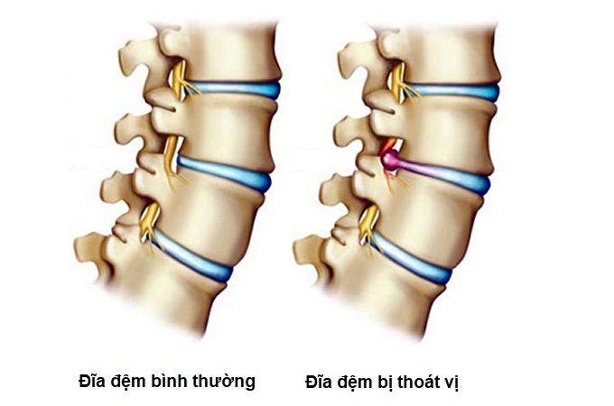 Thoát vị cột sống