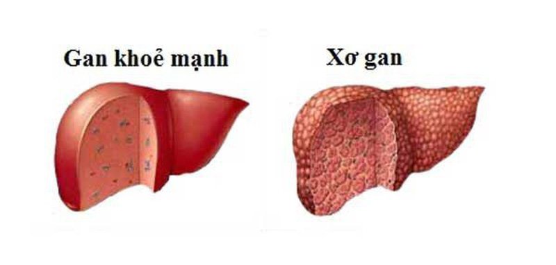 Viêm gan B mãn tính có thể gây xơ gan