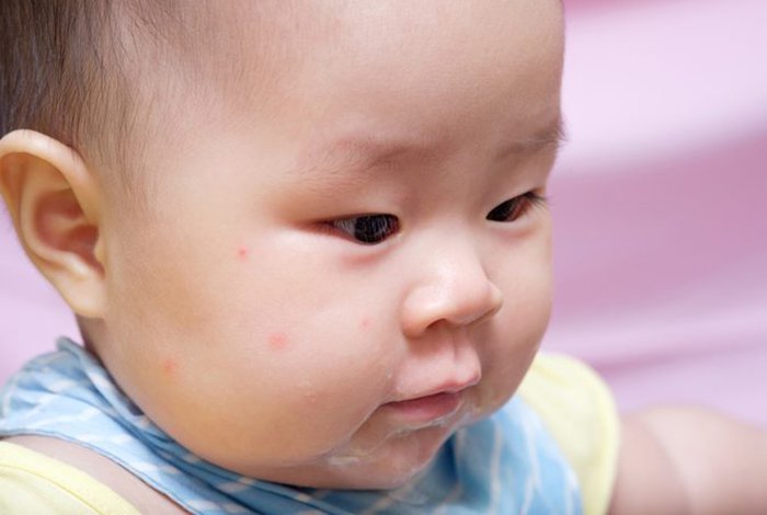 Mụn trứng cá ở trẻ sơ sinh còn được gọi là nang kê hay mụn sữa