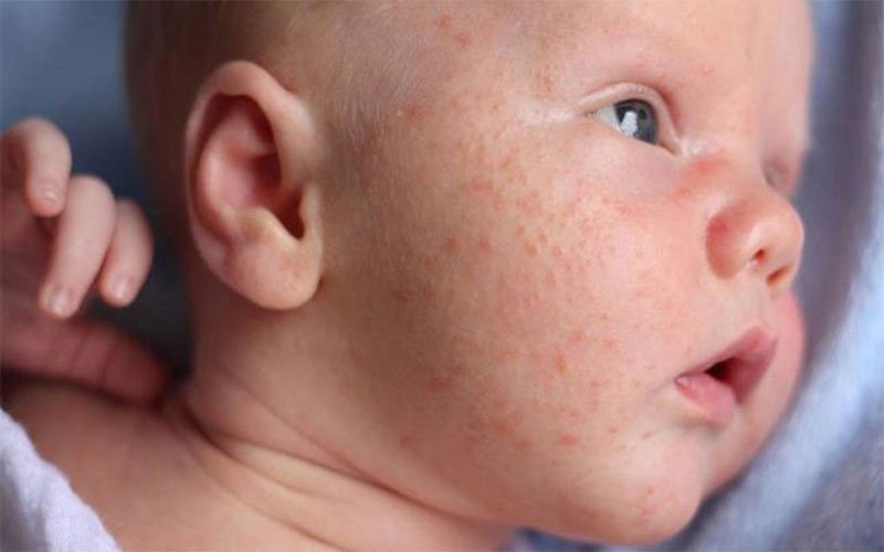 Rôm sảy xuất hiện khi cơ thể trẻ bị nóng quá