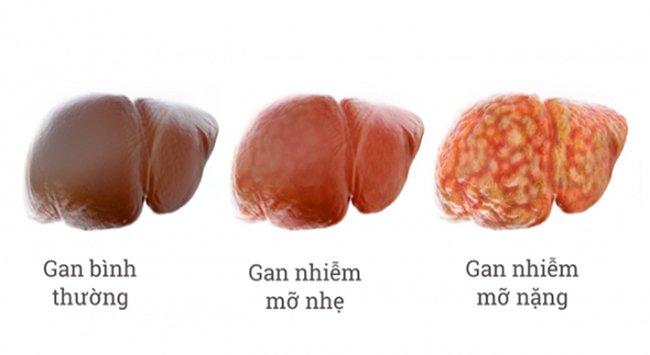 Có 3 cấp độ của bệnh gan nhiễm mỡ