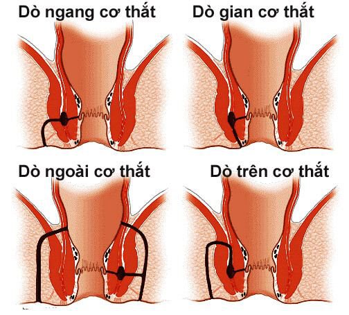 Nguyên nhân lỗ rò hậu môn và Cách điều trị - ảnh 1