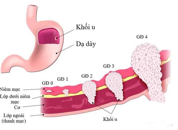 Những điều cần biết về ung thư dạ dày - ảnh 4