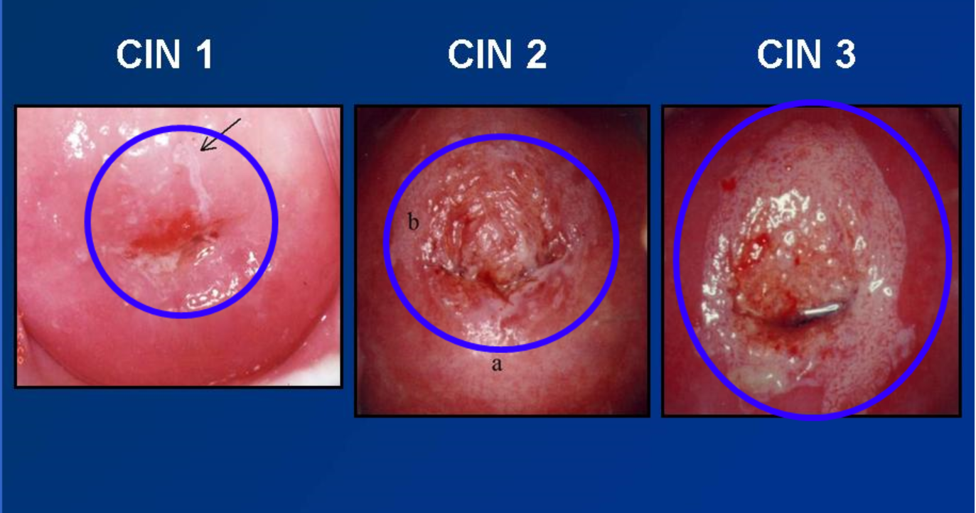 CIN