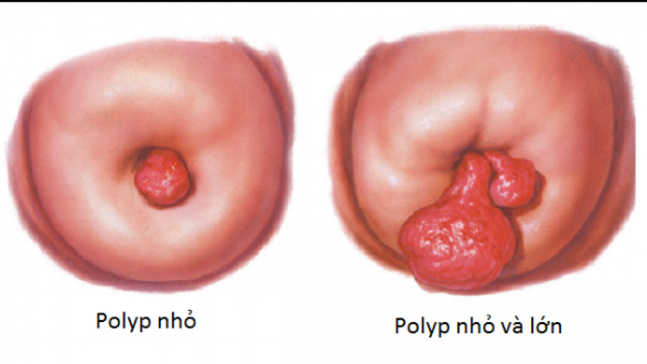 Polyp buồng tử cung