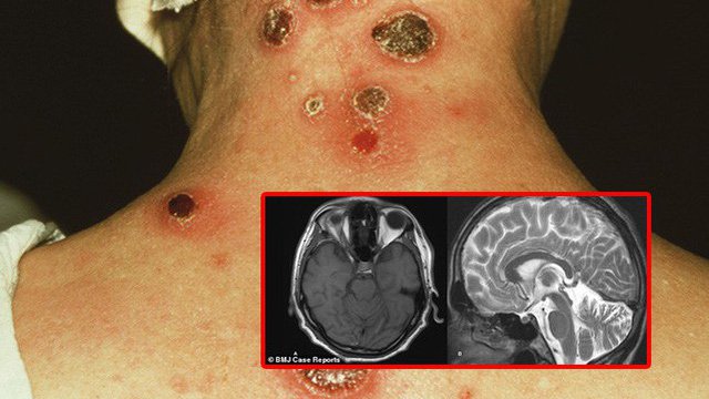 Giang mai thần kinh