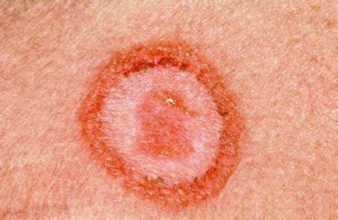 Đặc điểm bệnh giang mai giai đoạn đầu