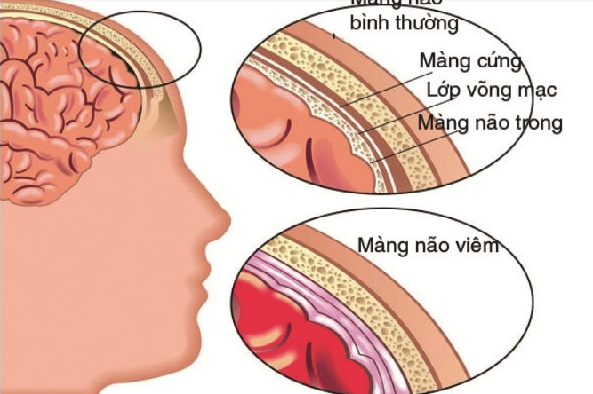 Viêm màng não