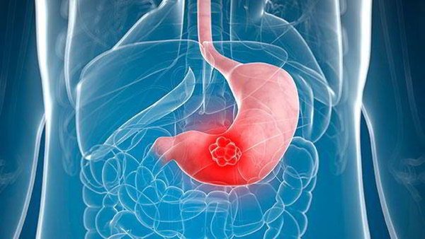 Trào ngược mật: Nguyên nhân, triệu chứng - ảnh 2