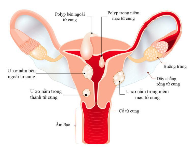 Nội soi bóc nhân xơ tử cung