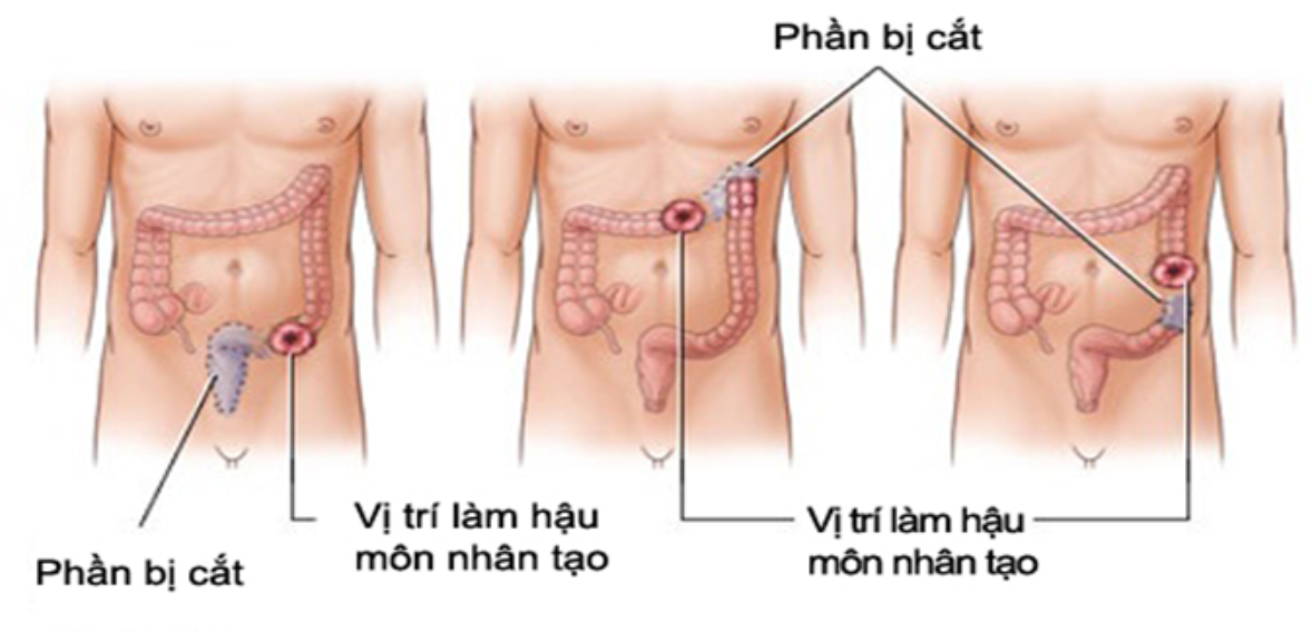 Hậu môn nhân tạo