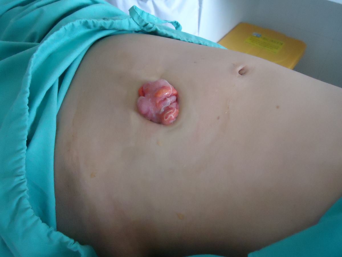 Biến chứng hậu môn nhân tạo thường gặp và Cách chăm sóc - ảnh 2