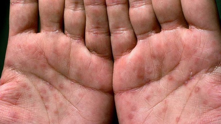 Giang mai giai đoạn 2