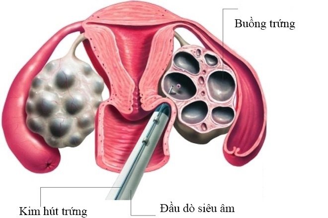 Chọc hút trứng qua đường âm đạo