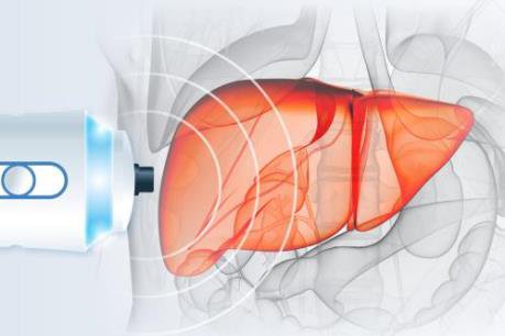 Fibroscan