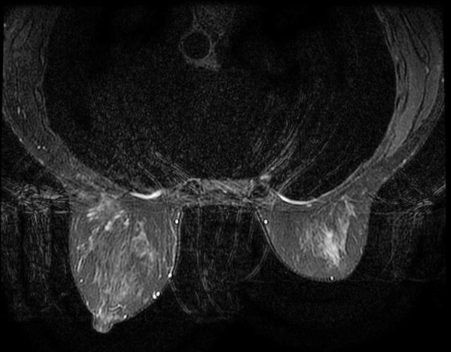 Tuyến vú cộng hưởng từ