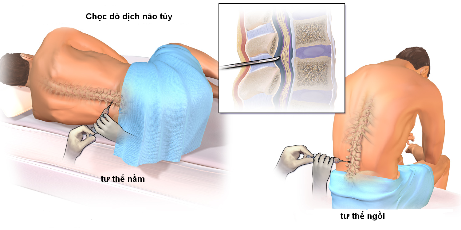 Dịch não tủy