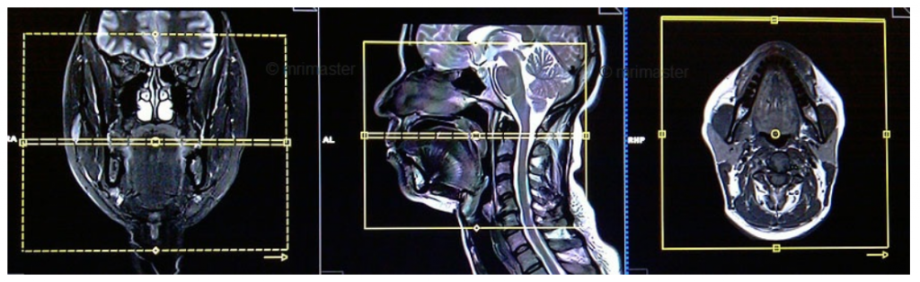 MRI mặt cổ