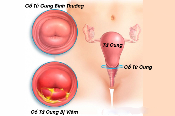 Viêm cổ tử cung: Nguyên nhân và triệu chứng cảnh báo