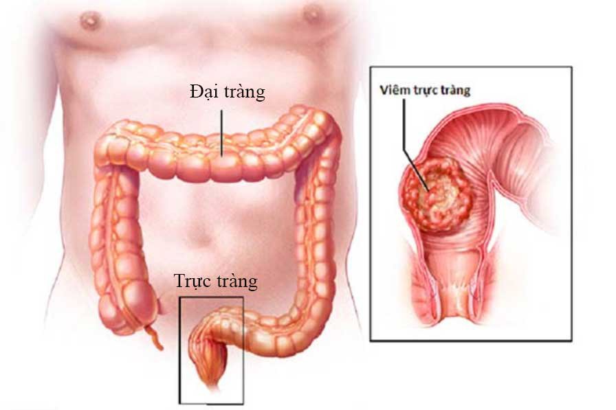 Khi nào cần nội soi trực tràng? - ảnh 2