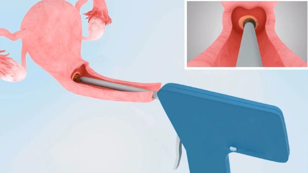 Áp lạnh cổ tử cung