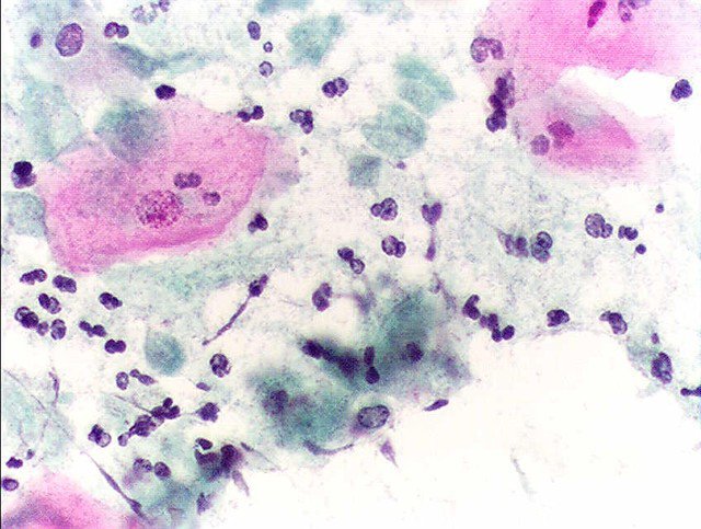 Trùng roi âm đạo Trichomoniasis