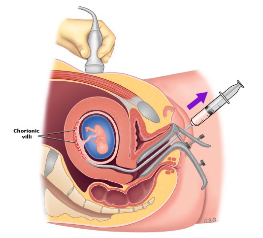 Sinh thiết gai nhau qua cổ tử cung
