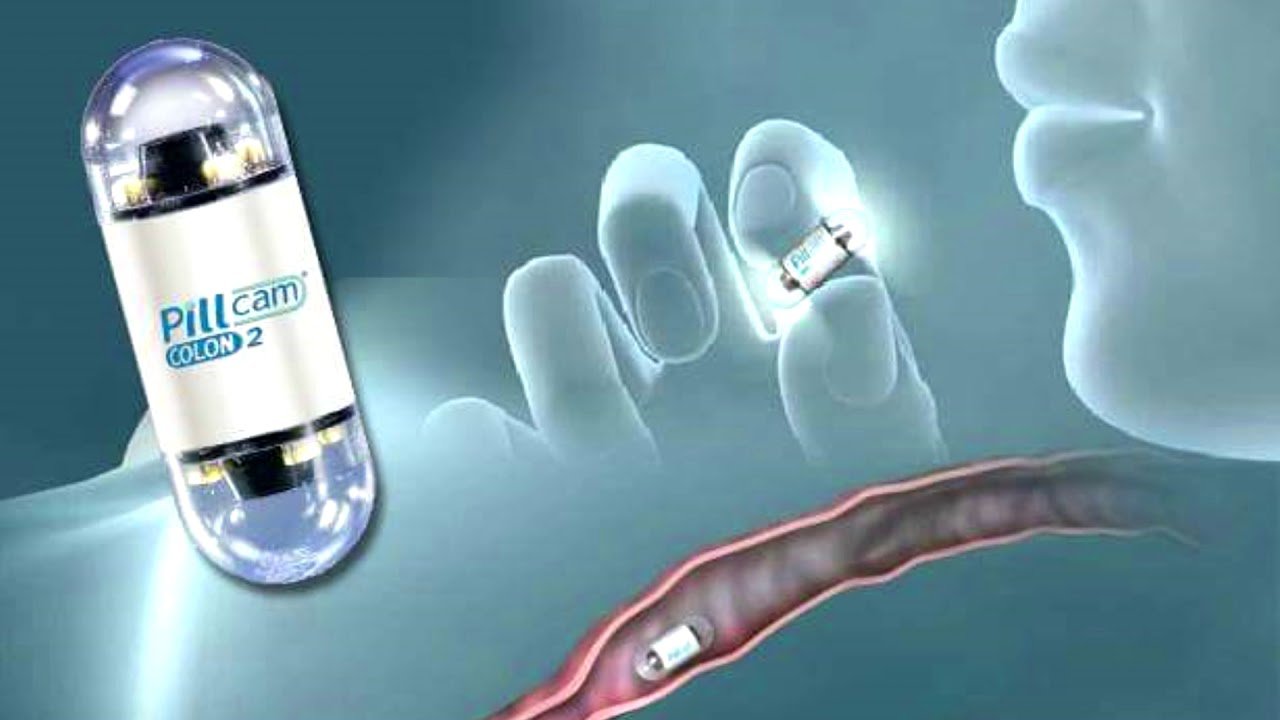 Tìm hiểu phương pháp nội soi dạ dày viên nang - ảnh 1