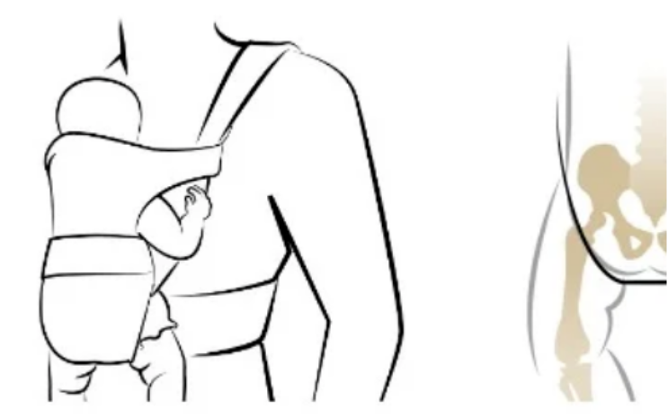 Loạn sản khớp háng