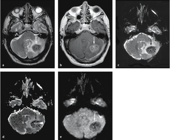 Chụp cộng hưởng từ khuếch tán (DWI-Diffusion-weighted Imaging)