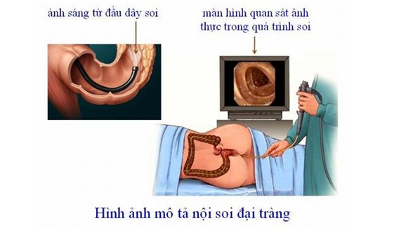 Nội soi đại tràng