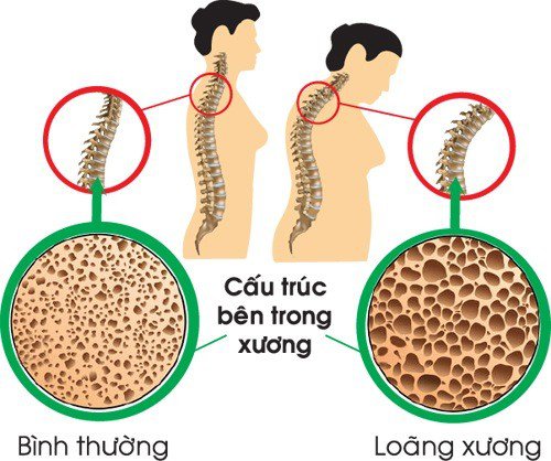 Điều trị loãng xương ở phụ nữ mãn kinh