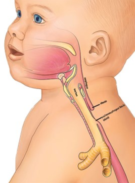 Phẫu thuật điều trị teo thực quản - ảnh 1