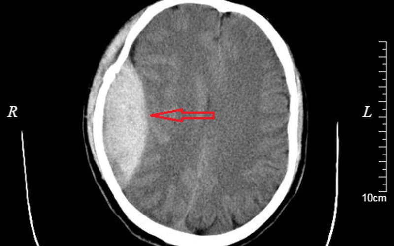 Máu tụ dưới màng cứng CT- Scan