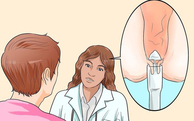 Điều trị trĩ ngoại: Những điều cần biết - ảnh 6