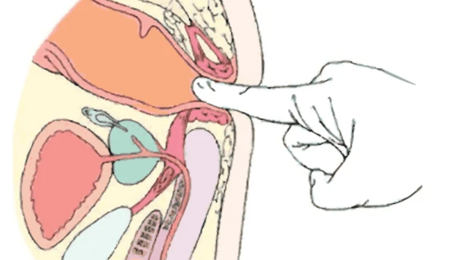 Nong hậu môn sau phẫu thuật có hẹp - ảnh 3