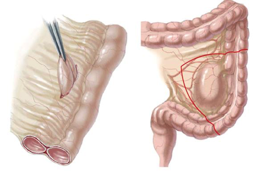 Nang ruột đôi là bệnh gì? và Cách điều trị - ảnh 1