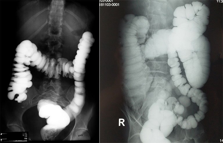 Đại tràng cản quang