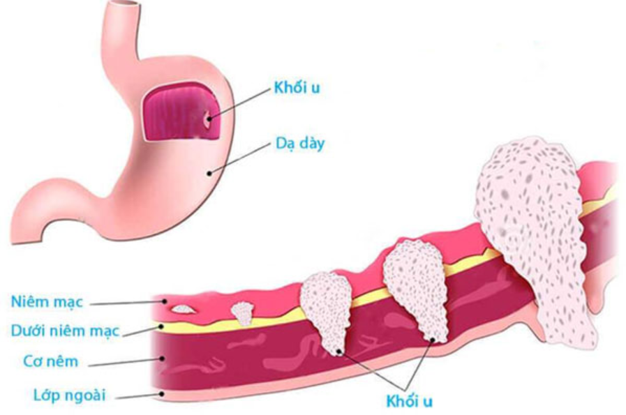 Cắt dạ dày do ung thư: Những điều cần lưu ý - ảnh 4