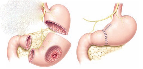 Cắt dạ dày do ung thư: Những điều cần lưu ý - ảnh 5
