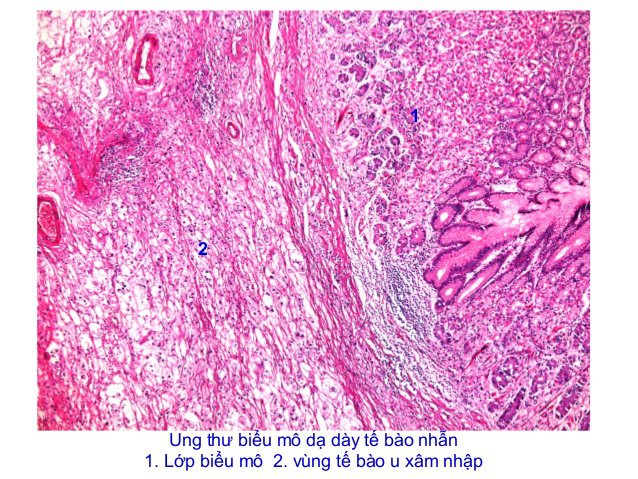 Cắt dạ dày do ung thư: Những điều cần lưu ý - ảnh 8