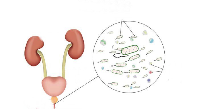 Viêm niệu đạo do lậu: Những điều cần biết