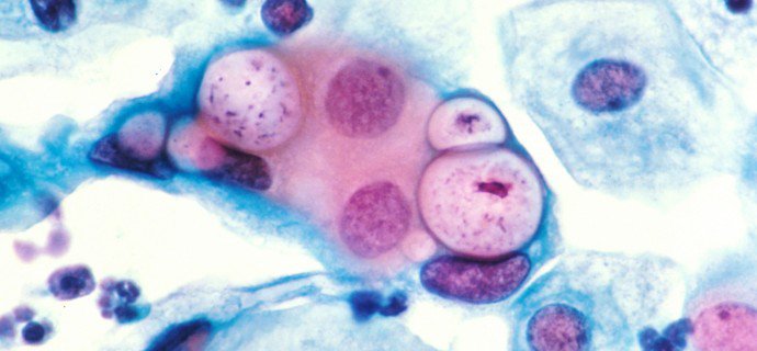 Chlamydia Trachomatis