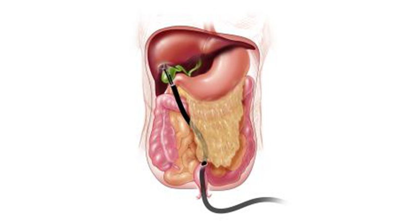 Phẫu thuật tạo van chống trào ngược dạ dày – thực quản qua nội soi - ảnh 2